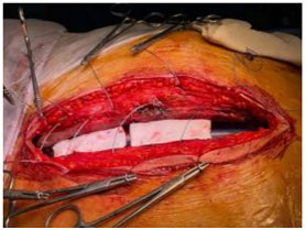 Sternal bleeding control using gelatin patches 