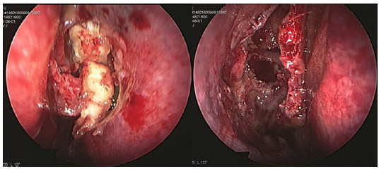 Endoscopic findings
