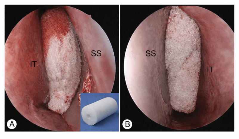 Endoscopic view of SURGISPON nasal pack placed after septoplasty for haemostasis