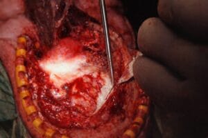 SURGI ORC - INDICATIONS - B