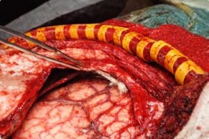 SURGI ORC - INDICATIONS - C