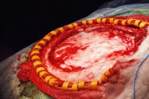 SURGI ORC - INDICATIONS - D