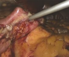 1.-FLOGEL-SURGERY---Flowable-Haemostatic-Matrix-application-over-the-staple-line 1.-FLOGEL-SURGERY---Flowable-Haemostatic-Matrix-application-over-the-staple-line