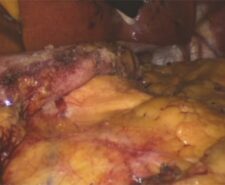 2.-FLOGEL-SUGERY----Flowable-Haemostatic-Matrix-application-at-the-end-of-sleeve-gastrectomy-procedure 2.-FLOGEL-SUGERY----Flowable-Haemostatic-Matrix-application-at-the-end-of-sleeve-gastrectomy-procedure