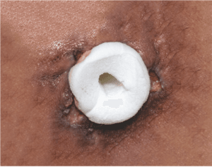 SURGISPON - Anal Tampon SURGISPON - Anal Tampon