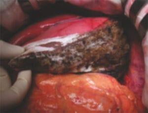 Surgi-ORC---INDICATIONS-SURGERY Surgi-ORC---INDICATIONS-SURGERY